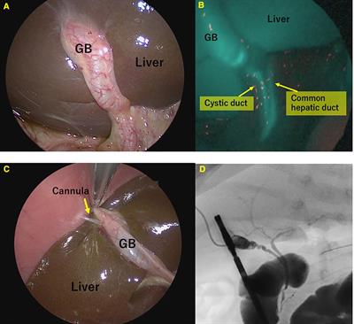 Intraoperative indocyanine green fluorescence cholangiography can rule out biliary atresia: A preliminary report